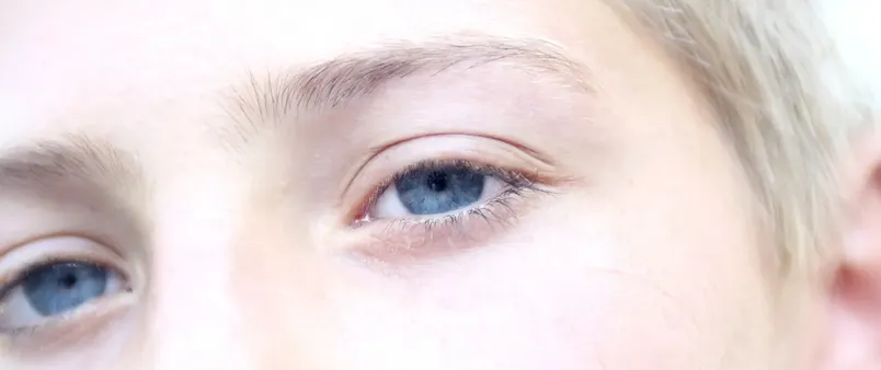 hooded-eye-botox-eyebrow-lift-1