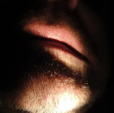 lip-augmentation