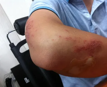 Does Botox Cause Bruising? 2 does-botox-cause-bruising-2