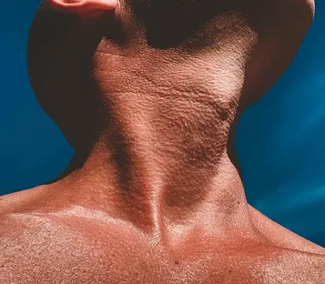 botox-for-jawline-1