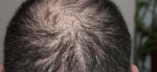can botox cause hair loss