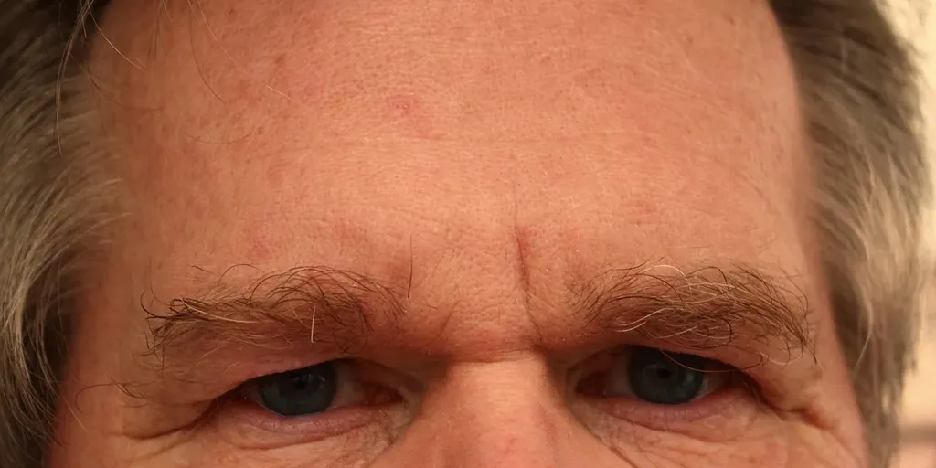 Botox Blemishes on the Forehead 2 how do you get rid of bruising from botox
