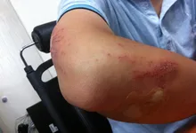 pictures bruising after dermal fillers 1