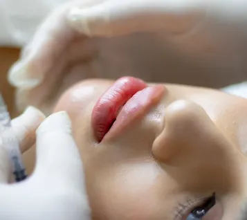 bruising after lip filler 4