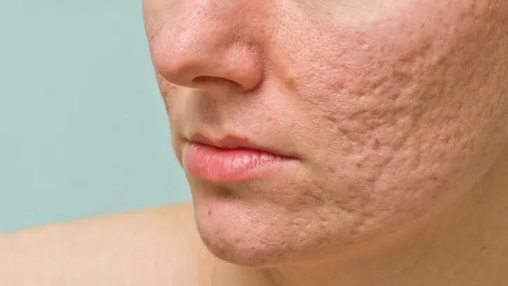 Botox Bruising