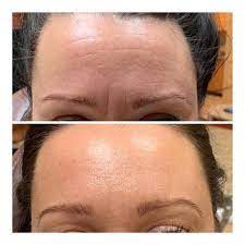 Botox Bruising Forehead 
