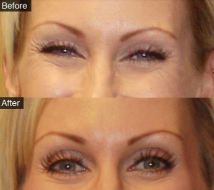 before-and-after-botox-crows-feet