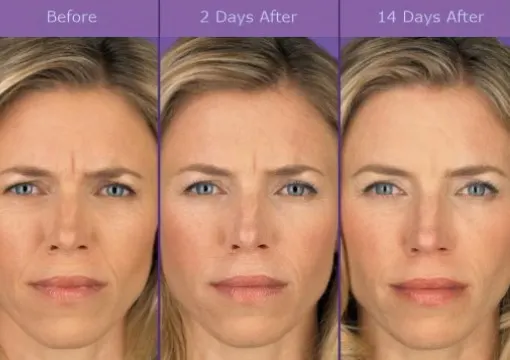 Botox Bruising Forehead 1 botox-bruising-forehead