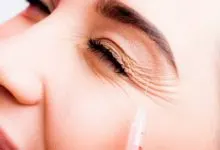 botox crows feet before and after