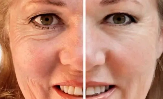 botox-for-crow's-feet-before-and-after