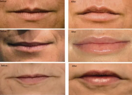 bruising-after-botox-7