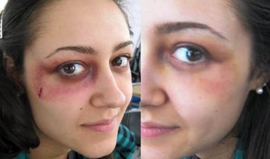 bruising-after-botox-around-eyes-2