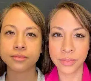 bruising-after-cheek-filler-1