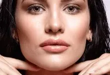 bruising-after-cheek-filler-3