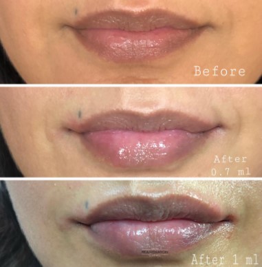 bruising-after-lip-filler-3