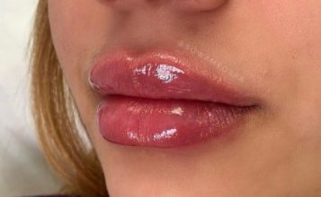 bruising after lip filler 4