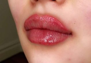 bruising-after-lip-filler-5