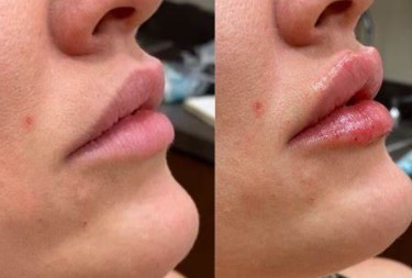 bruising-after-lip-filler-6