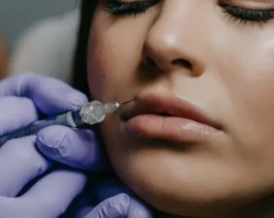 bruising-after-lip-fillers-2
