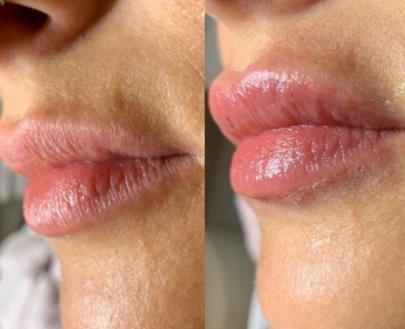 bruising-after-lip-fillers-3