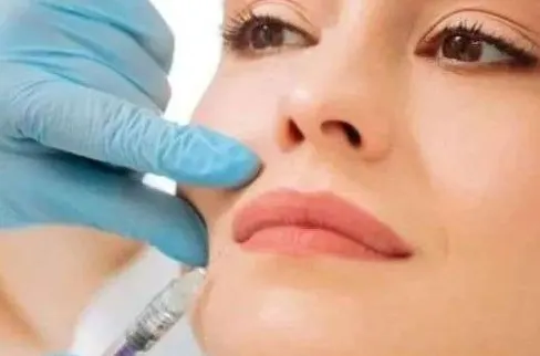 bruising after lip fillers