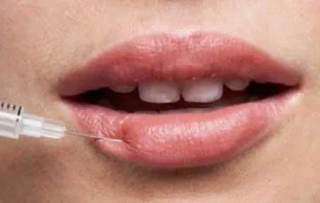 bruising-after-lip-injections
