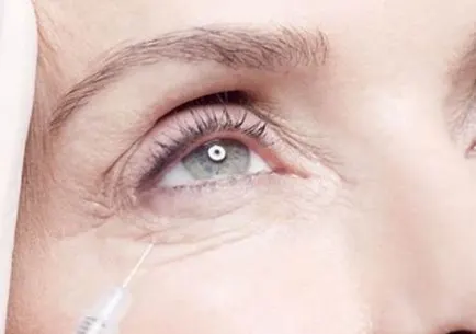 bruising from botox crows feet 1