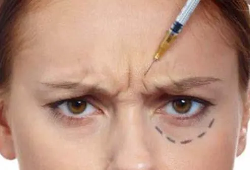bruising-from-botox-crows-feet