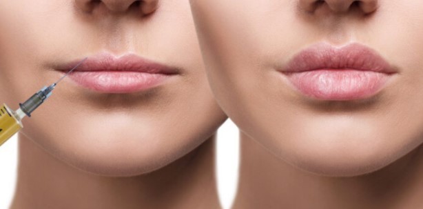 bruising-from-lip-fillers
