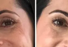 crows feet before and after botox 1