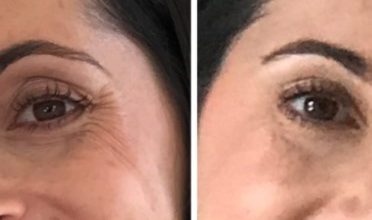 crows feet before and after botox 1