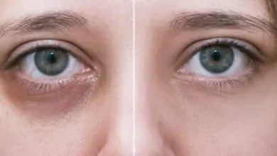 filler-under-eyes-bruising-2