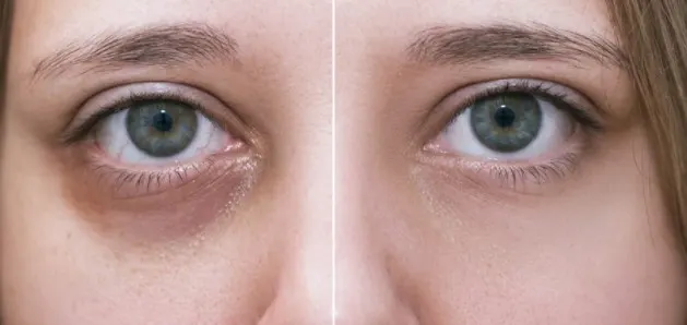 filler-under-eyes-bruising-2