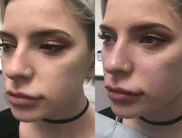 how-to-cover-bruises-from-filler-injections-1
