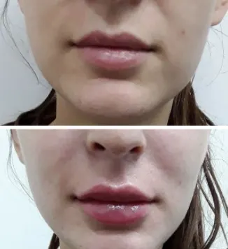 how-to-cover-bruises-from-filler-injections