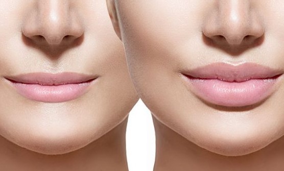 lip-filler-bruising-5