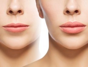 lip-filler-bruising-6