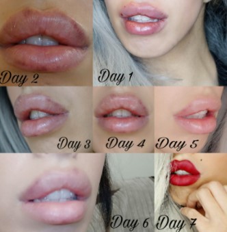 lip-filler-swelling-2