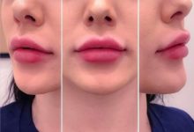 lip injections before after