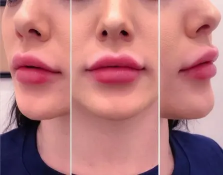 lip injections before after