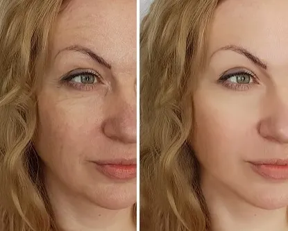 pictures bruising after dermal fillers 3