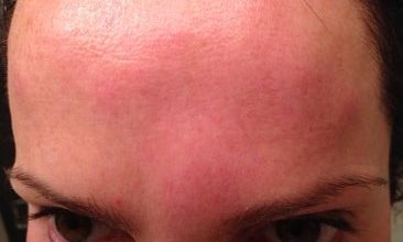 prevent botox bruising and swelling