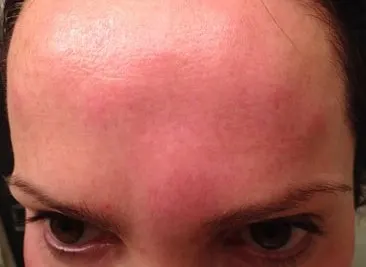 prevent botox bruising and swelling
