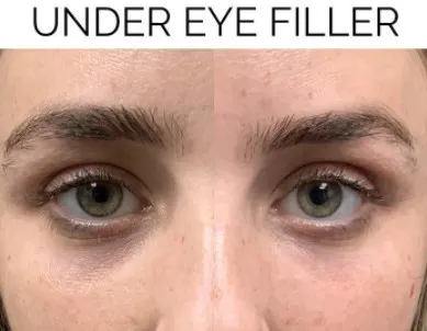 botox-bruising-around-the-eye-area-1