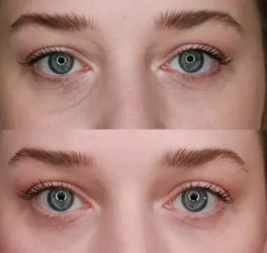 botox-bruising-around-eye-area