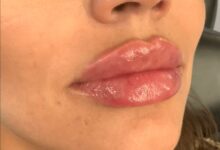 how long does lip filler last 1