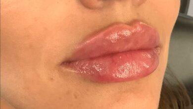 how long does lip filler last 1
