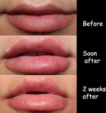 how-long-does-lip-filler-last