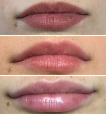 how-much-is-lip-filler-1