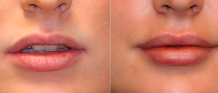lip-augmentation-surgery-1